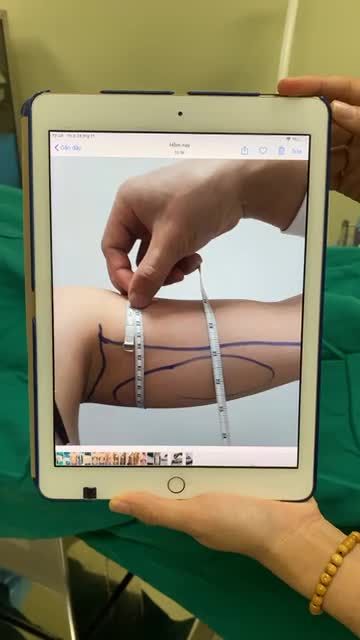 HÚT MỠ BẮP TAY AN TOÀN HIỆU QUẢ VỚI CÔNG NGHỆ LIPO MATIC 3D