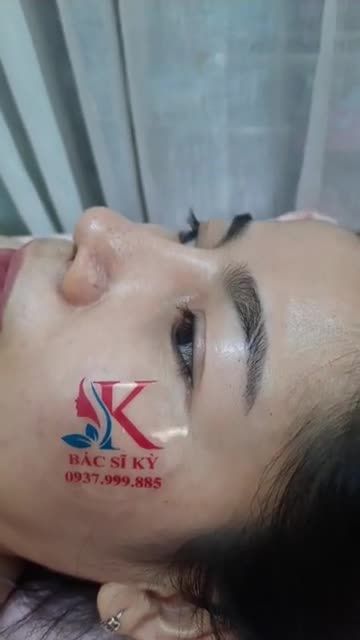 Live tream Nâng Mũi Bán Cấu Trúc Sụn Tai