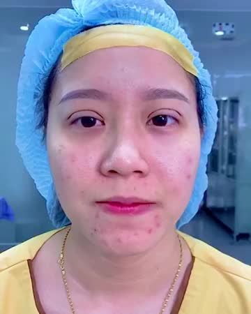 MÍ XINH LUNG LINH TÓA SÁNG - KHÁCH HÀNG CƯỜI TƯƠI NHƯ HOA SAU 45 PHÚT THỰC HIỆN TIỂU PHẪU CẮT MÍ TẠI CHI NHÁNH TP.HCM