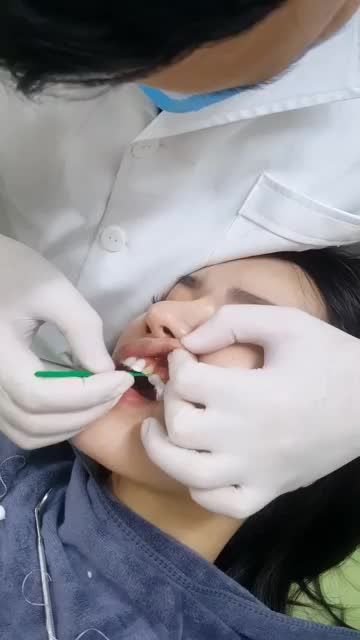DÁN SỨ VENEER CHƯA BAO GIỜ HẾT HOT!