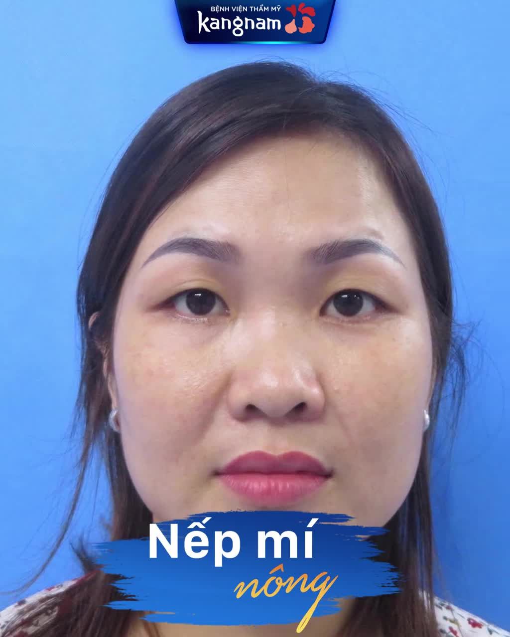 Sau 10 ngày Cắt mí + Nâng mũi - Mỹ nhân đây rồi!