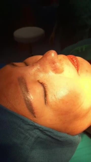 XỬ LÝ MŨI MỎNG DA, LỘ SỤN ĐẦU MŨI SAU 3 LẦN NÂNG MŨI Ở CƠ SỞ KHÁC
