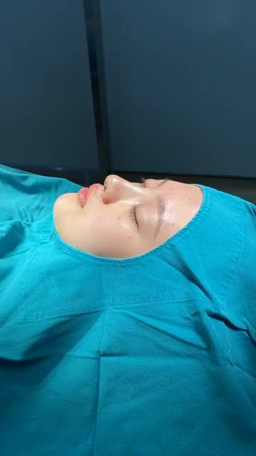 CA NÂNG MŨI SLINE VỪA XONG