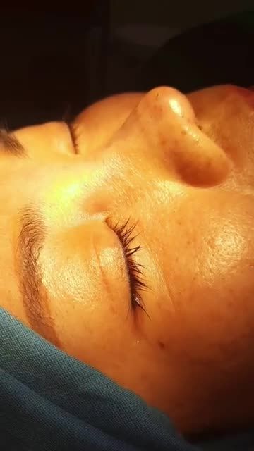 Nâng mũi Bán Cấu Trúc 2 Lớp Sau 45 phút thực hiện