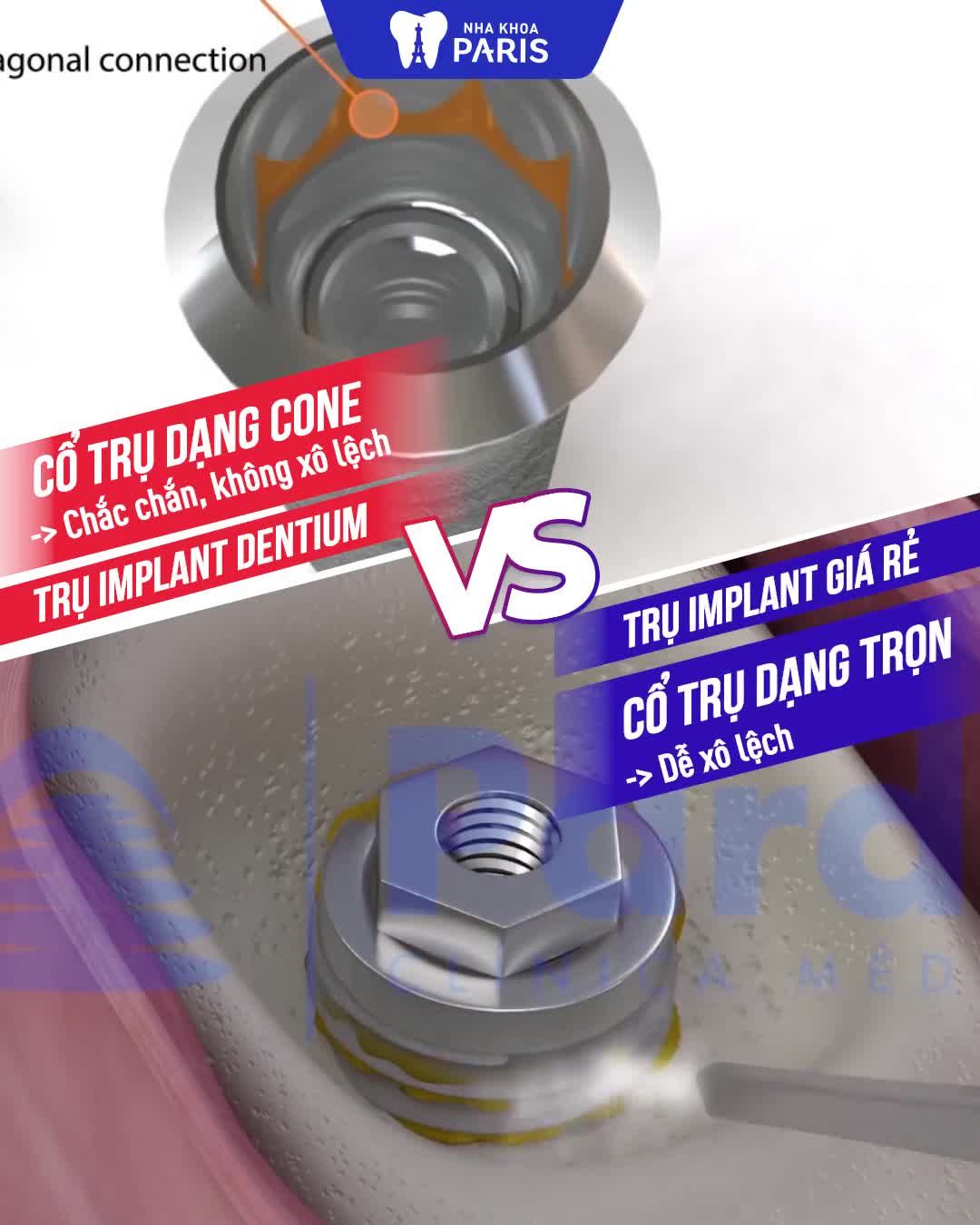 Muốn BẢO HÀNH TRỌN ĐỜI - chọn implant Dentium tại Paris