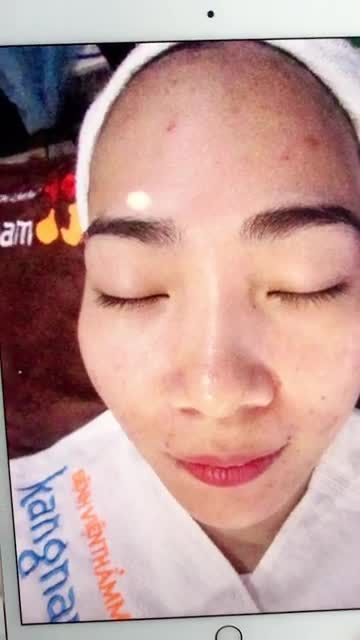 Sự thay đổi tuyệt vời của bạn gái sau khi thực hiện liệu trình trẻ hóa hồi sinh da