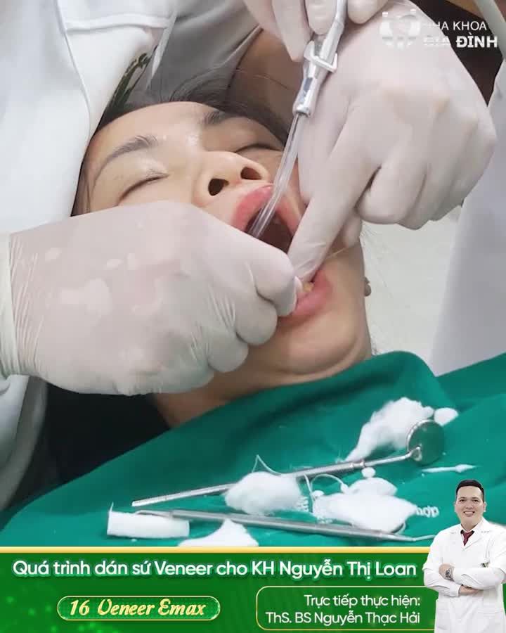 DÁN SỨ VENEER TRẢI NGHIỆM TUYỆT VỜI ĐỂ CÓ NỤ CƯỜI TƯƠI TẮN