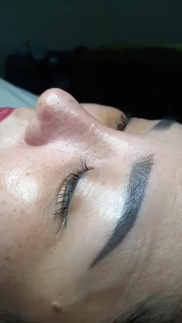 Tái khám Nâng Mũi Bán Cấu Trúc Sụn Tai Sau 8 Ngày Tháo Nẹp nhà Bs Kỳ