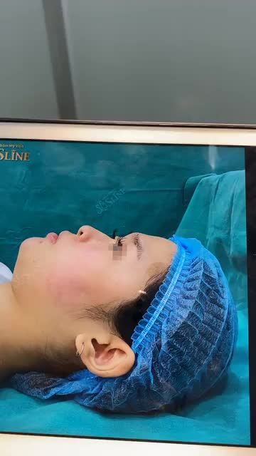 THAY ĐỔI DÁNG MŨI HOÀN HẢO CHỈ SAU 30 PHÚT