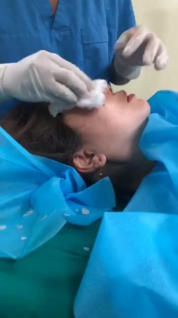 NÂNG MŨI S-Line CẮT MÍ TRÊN CẮT MÍ DƯỚI CẤY MỠ HỐC MẮT TRÊN CẤY MỠ HỐC MẮT DƯỚI