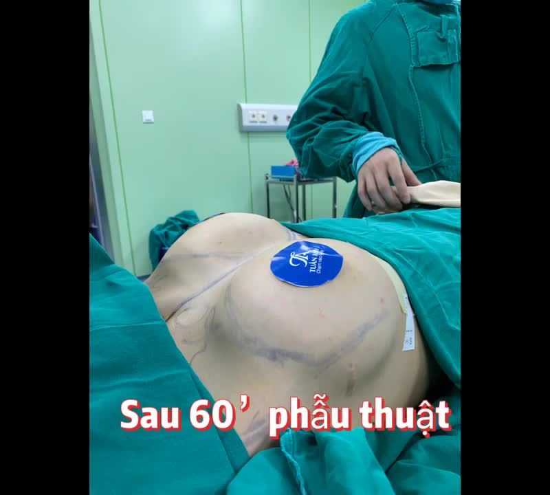Cùng theo dõi quá trình Khách hàng NÂNG NGỰC sau 2 Tuần nhé các chị(em).