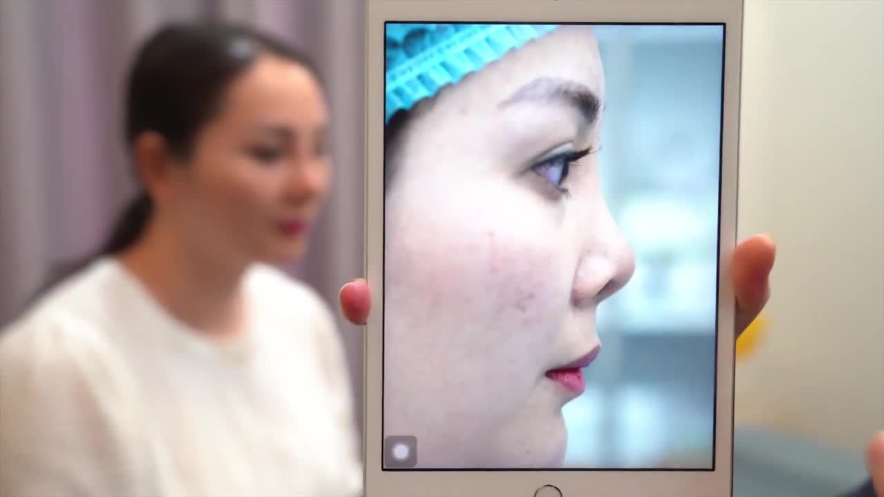 Dr Minh Phạm GIẢI CỨU CA MŨI SỬA 4 LẦN SIÊU KHÓ sau 7 ngày cắt chỉ !!!