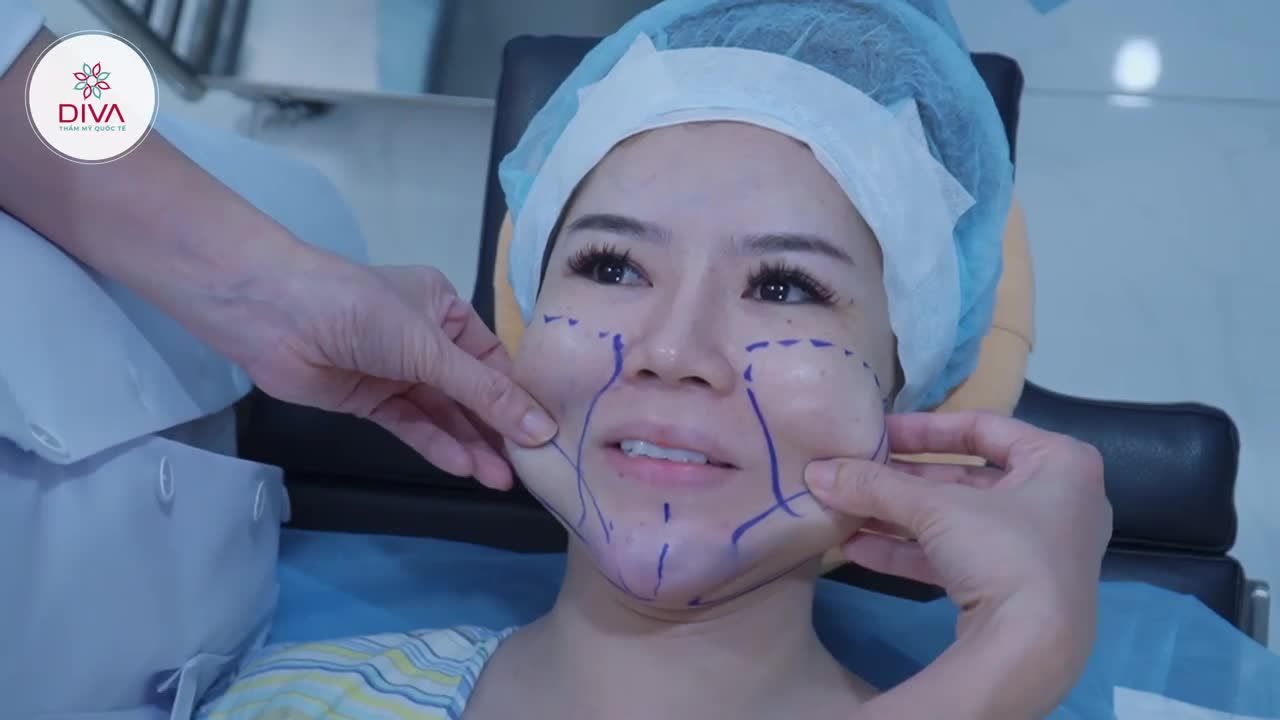 MẶT QUÁ TRÒN MỠ DÀY DƯỚI DA LÀM BẠN MẤT TỰ TIN ?