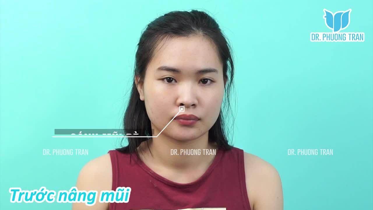 MŨI ĐẸP NGAY SAU PHẪU THUẬT LÀ CÓ THẬT