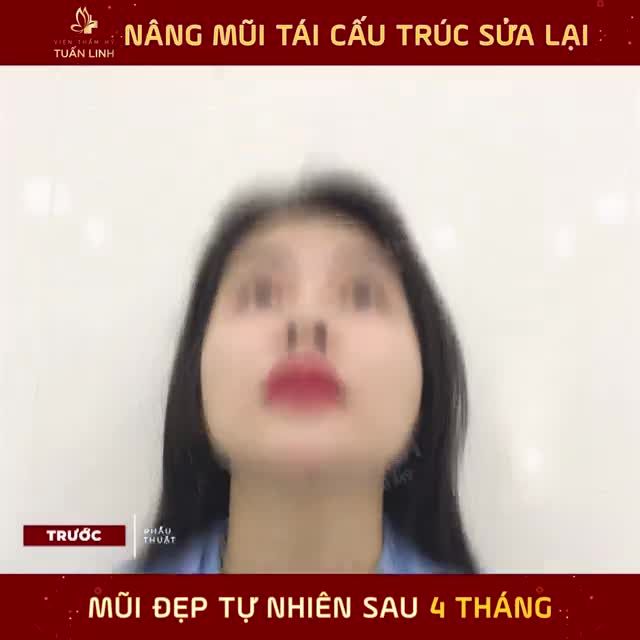 NÂNG MŨI TÁI CẤU TRÚC SỬA LẠI - ĐẸP NGAY SAU 4 THÁNG