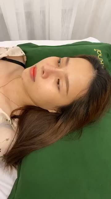 Niềm vui với dáng mũi cấu trúc sụn sườn xuất sắc sau 10 ngày tái khám.