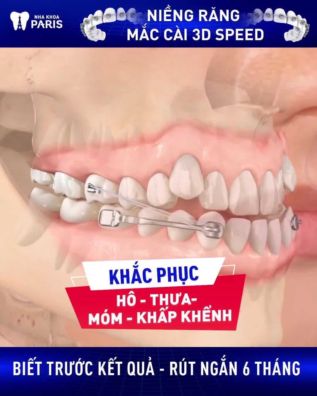 Niềng Răng Đều Đẹp Sau 6 Tháng Chỉ từ 24Tr
