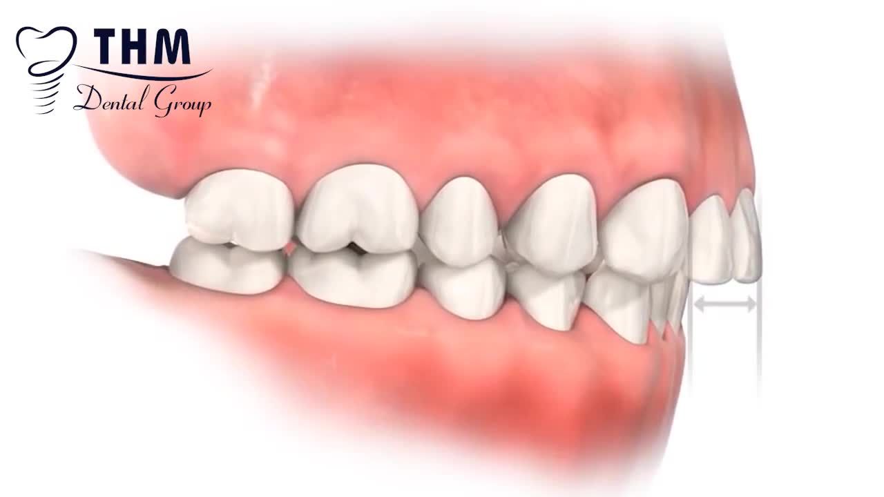 Răng hô không chỉ ảnh hưởng đến tính thẩm mỹ mà còn tác động đến sự tự tin của bạn