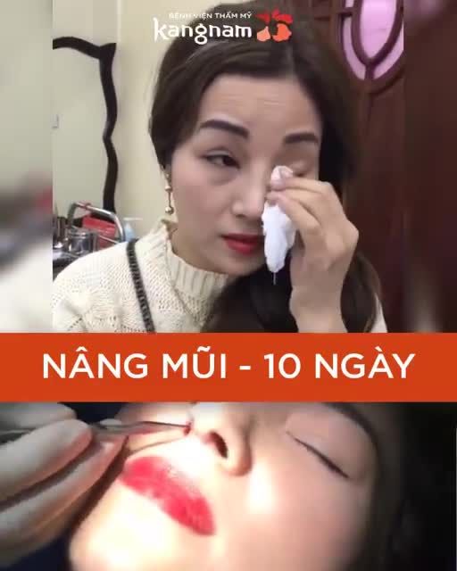 MŨI CAO - TỰ NHIÊN - KHÔNG HỀ SƯNG BẦM sau Nâng mũi