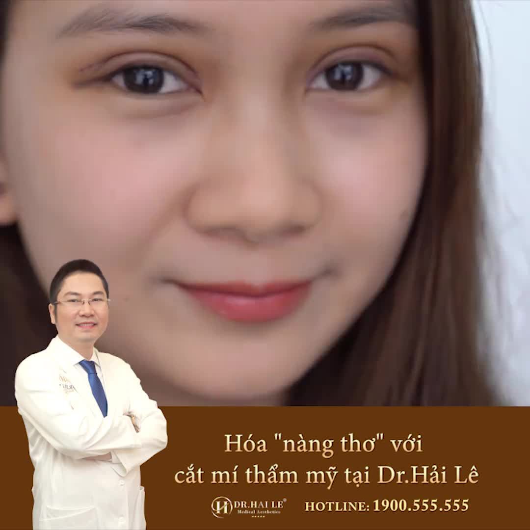 NÀNG THƠ Có ai mê mẩn nếp mí này không ạ? Thả tim cho Dr.Hải Lê nhé!