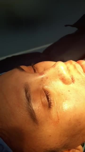Nâng mũi bán cấu trúc đa lớp Kết hợp cuộn cánh mũi plasma