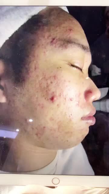 Trải nghiệm công nghệ trị mụn hiện đại nhất NanoSkin với chi phí thấp nhất