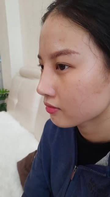 TÁI KHÁM NÂNG MŨI BÁN CẤU TRÚC ĐA LỚP BS KỲ Y DƯỢC