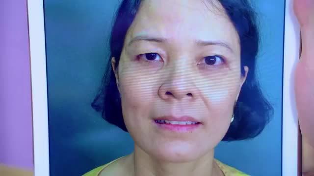 GIẢI CỨU THÀNH CÔNG 1 CA MÍ KHÓ GIÚP VỊ KHÁCH HÀNG RŨ BỎ ĐÔI MẮT "DỮ KHÓ GẦN SUỐT HƠN 30 NĂM