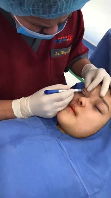 Muốn cắt mí nhưng lo sợ nếp mí quá to, không tự nhiên?
