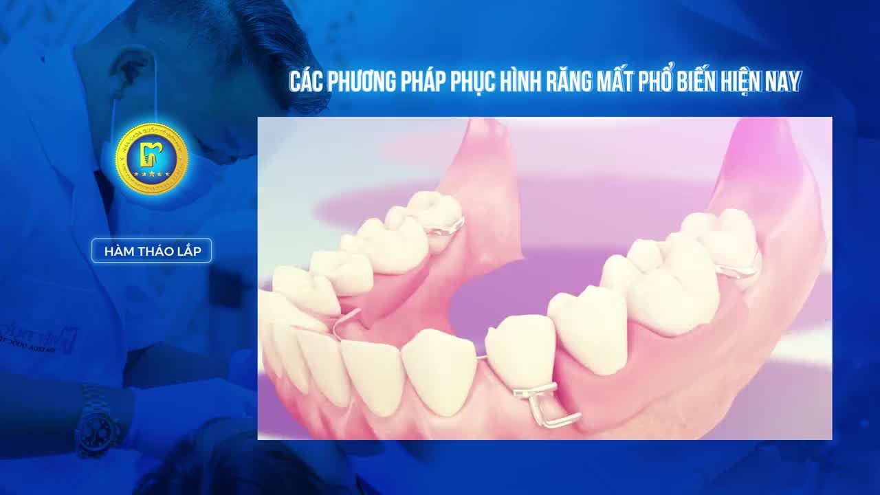 CÁC PHƯƠNG PHÁP PHỤC HÌNH RĂNG MẤT