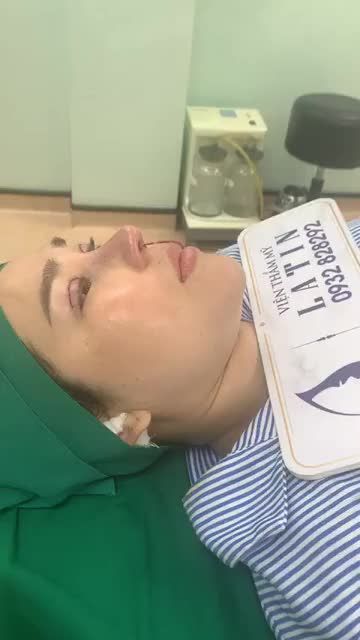 Combo mũi cấu trúc cắt mí 4D sửa lại do làm nơi khác bị lỗi