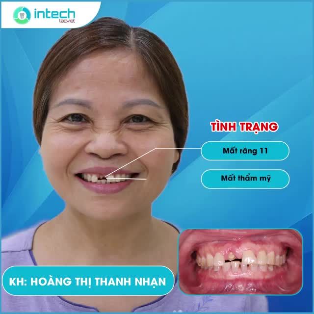 GIẢI PHÁP NÀO CHO KHÁCH HÀNG ĐÃ MẤT NHIỀU RĂNG CỬA?