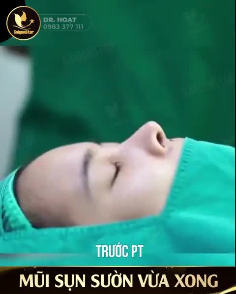 MŨI SỤN SƯỜN VỪA XONG