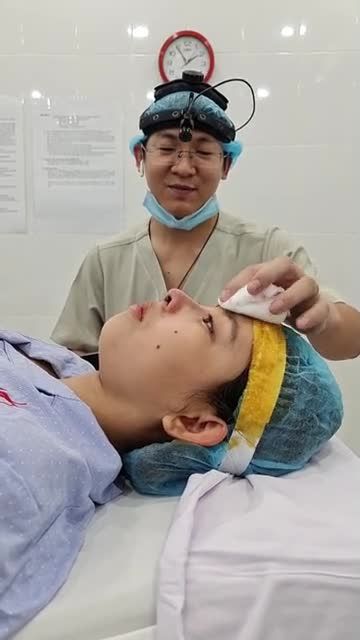 NÂNG MŨI CẤU TRÚC CHỈNH XƯƠNG VỪA THỰC HIỆN XONG