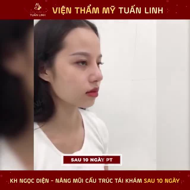 NÂNG MŨI CẤU TRÚC SAU 10 NGÀY ĐÃ ĐẸP CHƯA