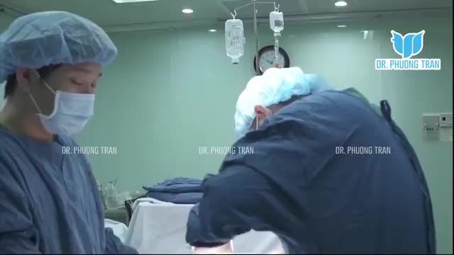 Nâng mũi cấu trúc sụn sườn Surgiform.