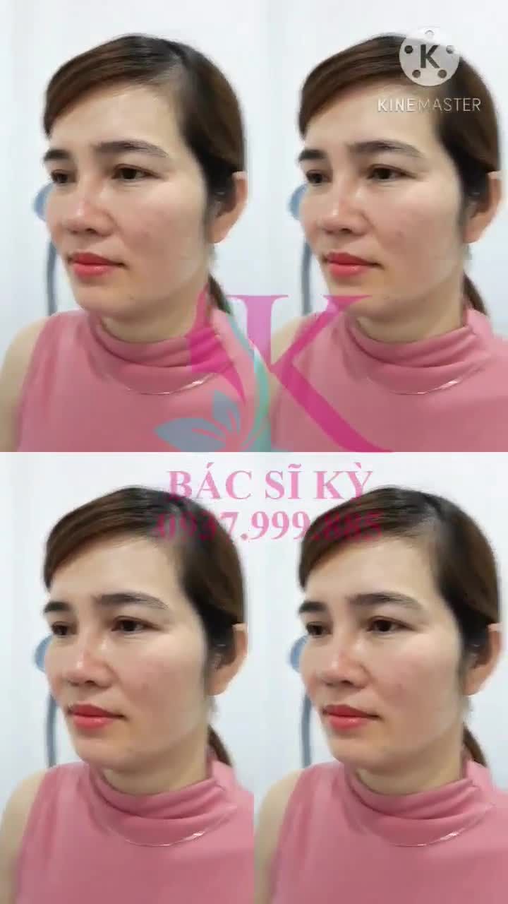 NÂNG MŨI NHÀ BS KỲ Y DƯỢC THÁCH THỨC MỌI GÓC NHÌN