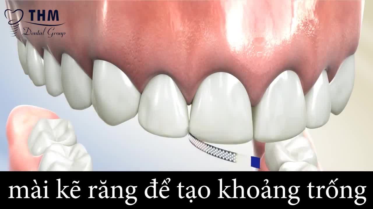 NHỮNG ĐIỀU CẦN BIẾT VỀ "NHỔ RĂNG" TRƯỚC KHI CHỈNH NHA
