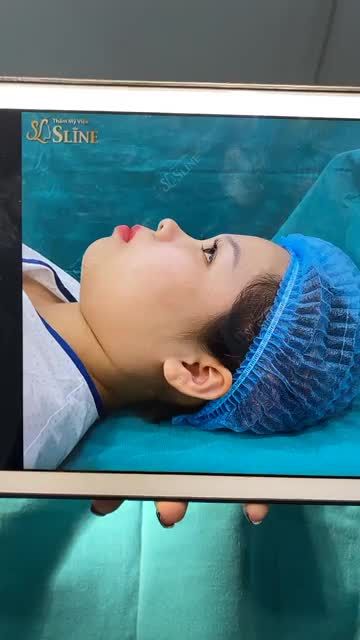 SỞ HỮU GÓC NGHIÊNG THẦN THÁNH NHỜ NÂNG MŨI SLINE