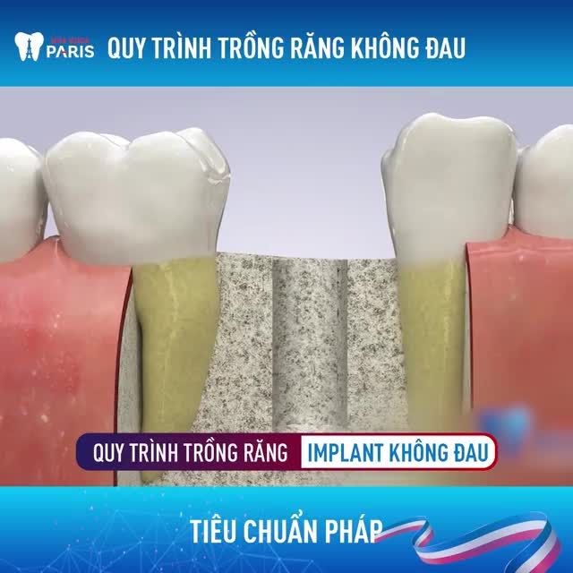 QUY TRÌNH THAY THẾ RĂNG MẤT VỚI CÔNG NGHỆ 4.0
