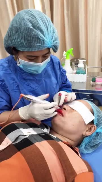 Quá trình phun môi khử thâm tại BV THẨM MỸ ĐÔNG Á. Tạm biệt nỗi lo môi thâm tự tin với đôi môi đỏ hồng