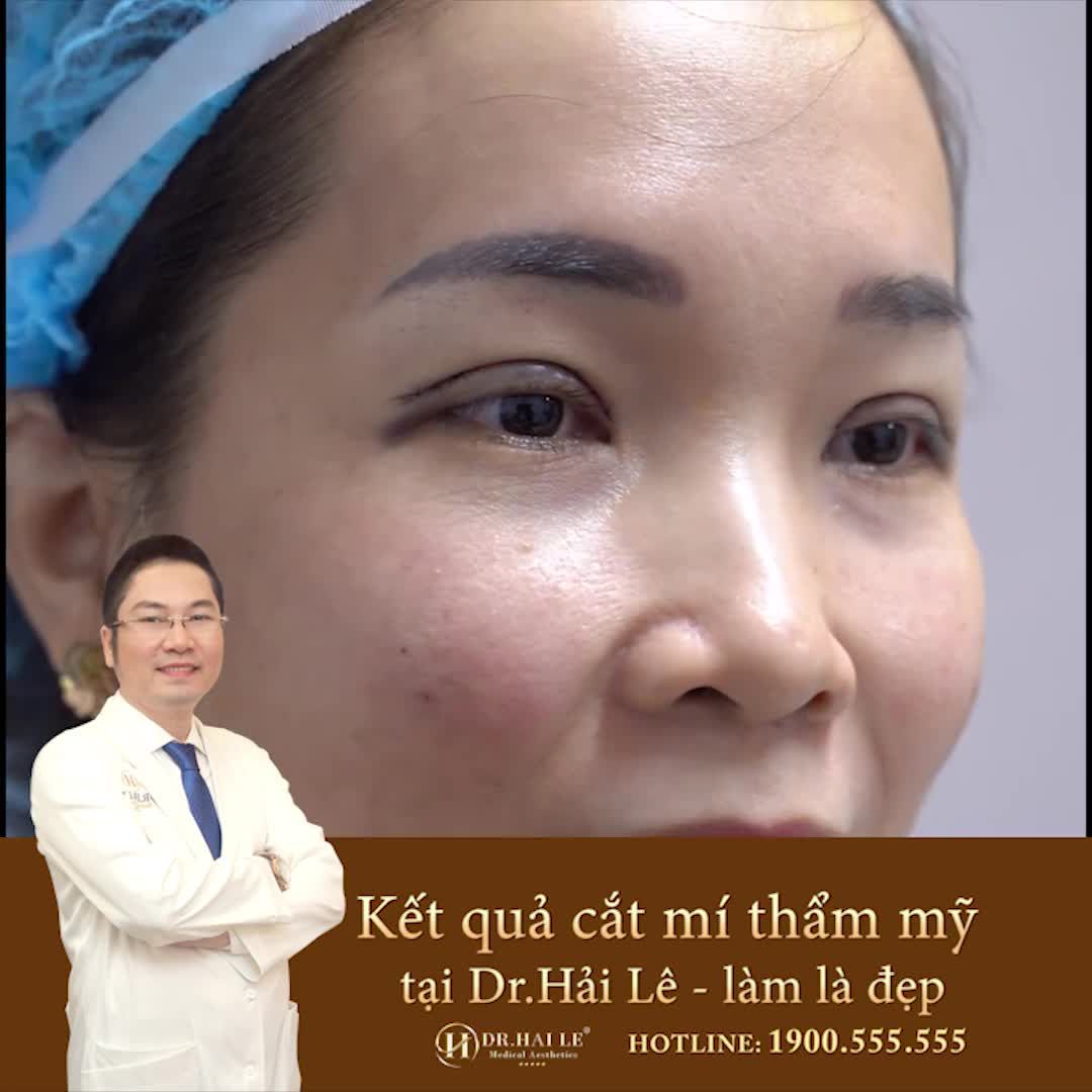 SỐNG CHUNG VỚI ĐÔI MẮT MỘT MÍ KÉM DUYÊN SUỐT HƠN 30 NĂM.!
