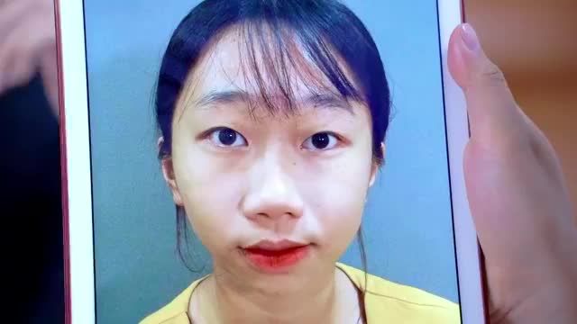 Mắt nhỏ 1 mí lệch to nhỏ khắc phục như thế nào sau tiểu phẫu Cắt mí mk