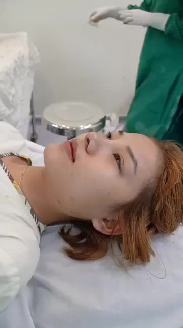 CA NÂNG MŨI CẤU TRÚC SỤN SURGIFORM CUỐI NGÀY VỪA ĐƯỢC BÁC SĨ HOẠT THỰC HIỆN XONG