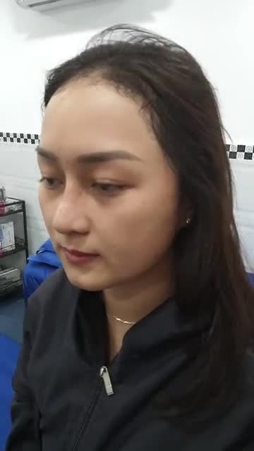 TÁI KHÁM NÂNG MŨI CAO TÂY CUỘN CÁNH MŨI SAU 10 NGÀY BẠN GÁI XINH NHƯ HOTGIRL