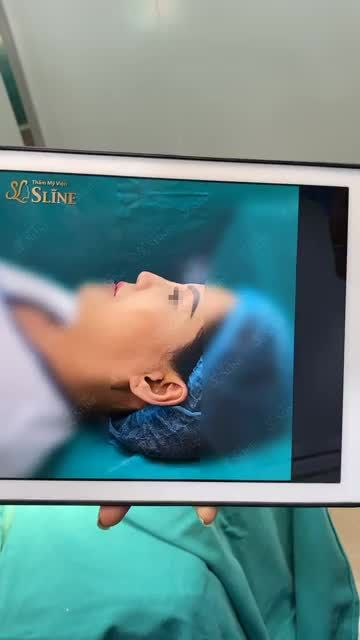 THAY ĐỔI DÁNG MŨI LỖI THÔ CỨNG VỚI NÂNG MŨI CẤU TRÚC SOFTXIL