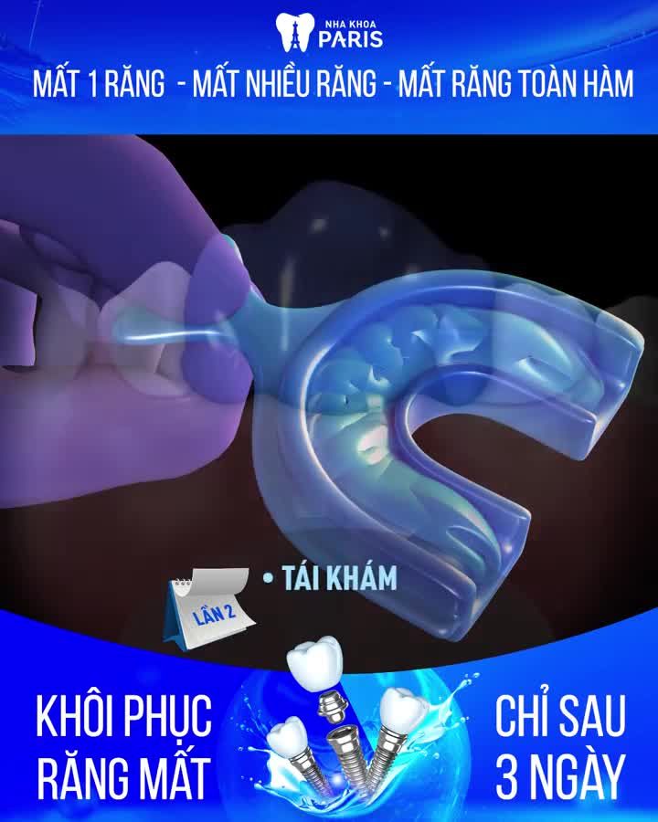 CHỈ 3 LẦN HẸN THAY THẾ RĂNG MẤT VỚI CÔNG NGHỆ 4.0