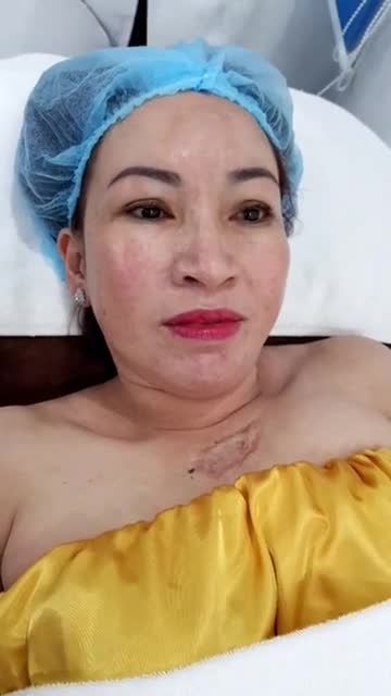 SẸO LỒI gây Ngứa? Mất thẩm mỹ? Khó chịu?