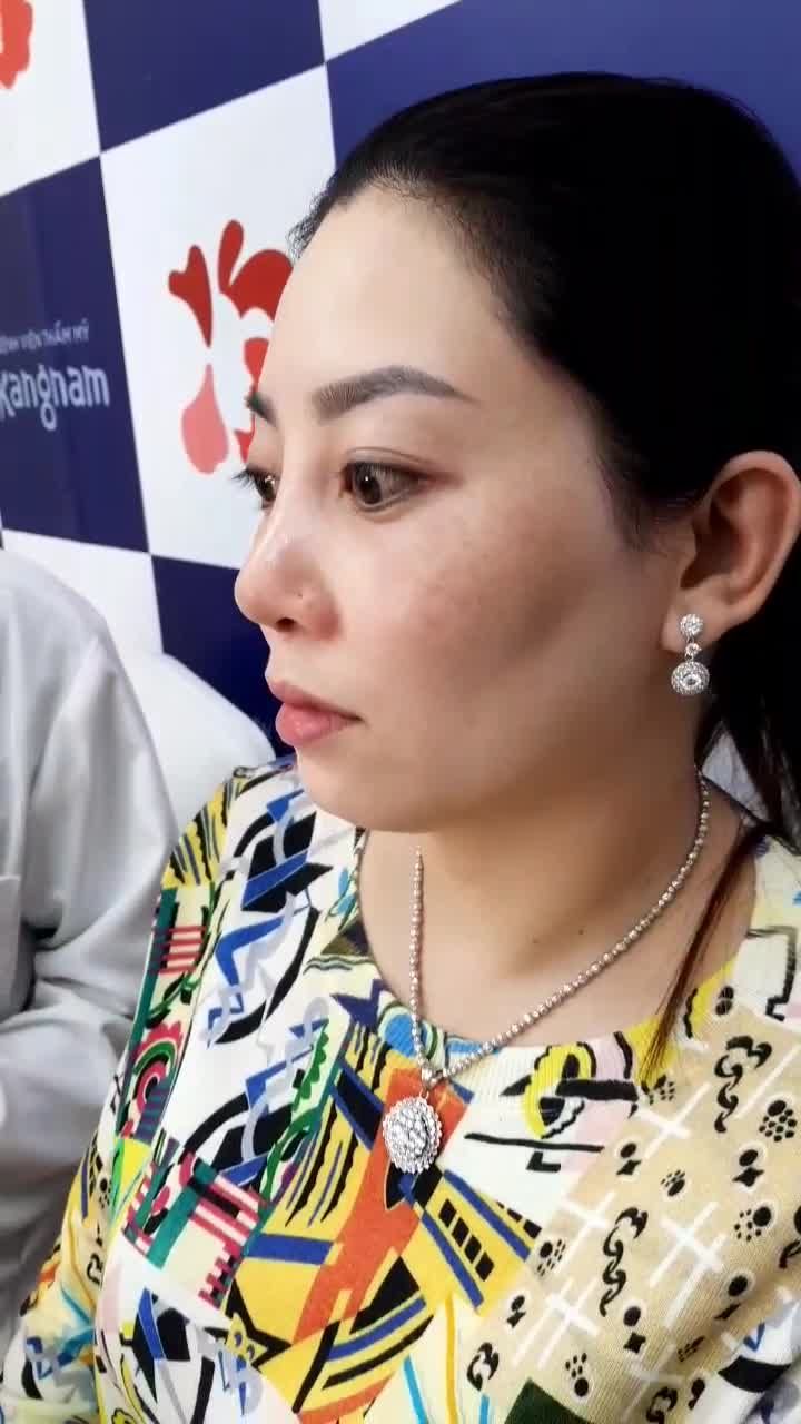 Mũi mới nâng 10 ngày mà cao thanh tú, lên phom Sline tự nhiên quá