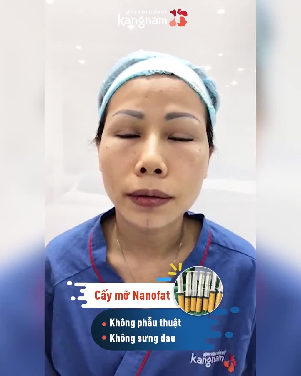 Cấy mỡ mặt Nano Fat- Trẻ hóa gương mặt tức thì